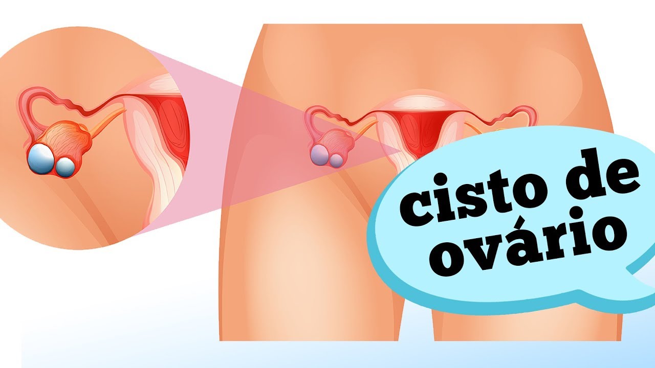 Quando se preocupar com um cisto de ovário?