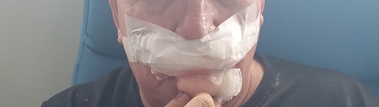 “Estou muito feliz por ter saido desta vivo!”, desabafa Mafrense atacado por Pit Bull