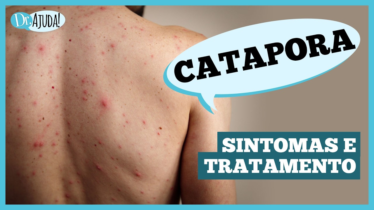 Catapora: sintomas, complicações e prevenção
