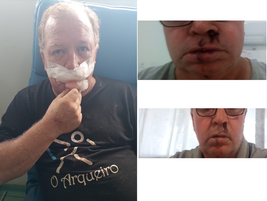 Ataque de Pit Bull: Pedrinho Ruthes fala sobre recuperaçao e deixa alerta